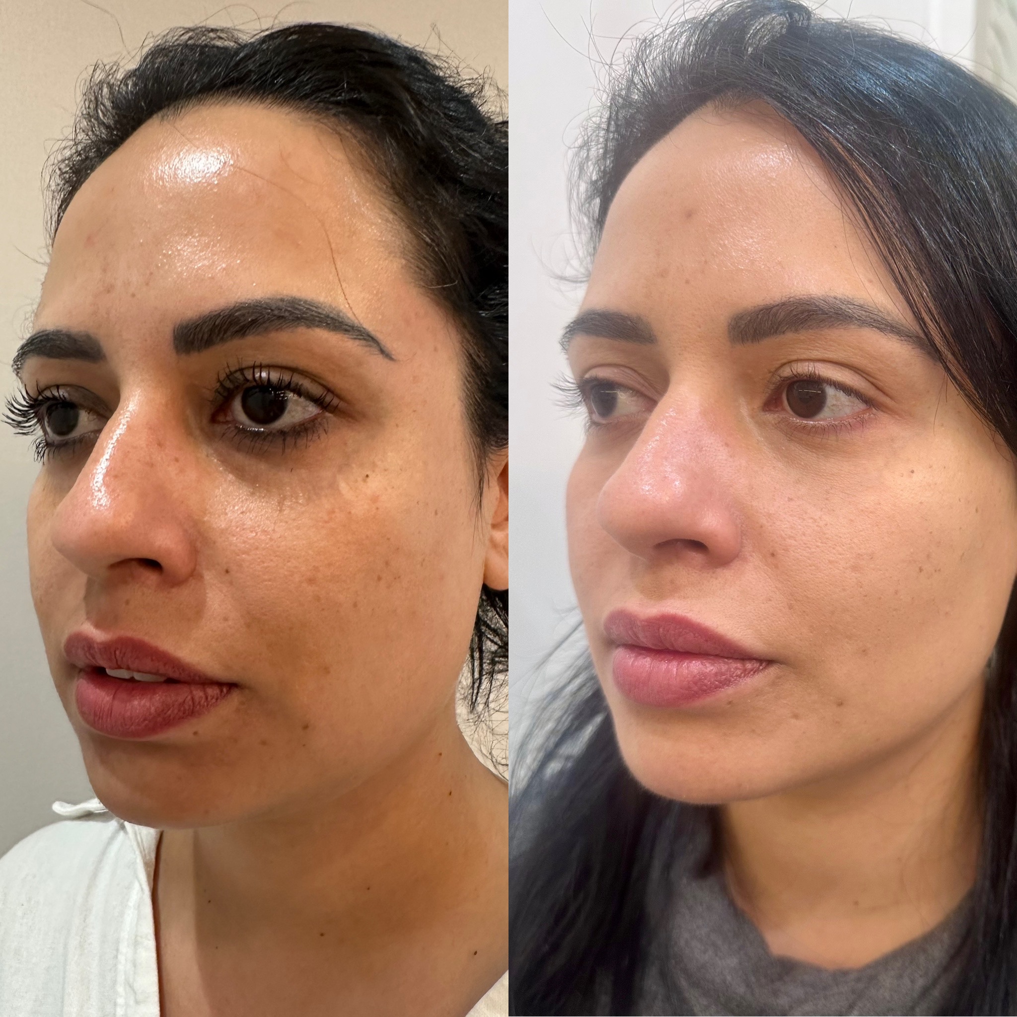Antes x Depois(meio perfil)